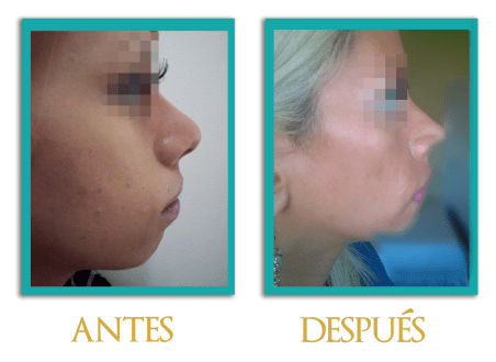 Rinoplastia-5